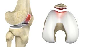 Chondromalacia Patella