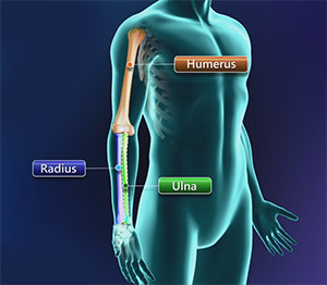 Cubital Tunnel Syndrome (Ulnar Nerve Entrapment)