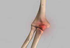 Elbow Injuries