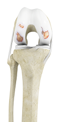 Osteoarthritis