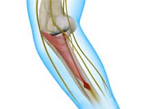 Radial Tunnel Syndrome