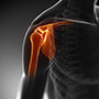 Overhead Athlete's Shoulder