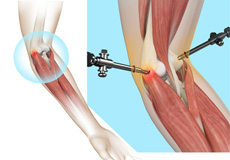 Tennis Elbow Surgery