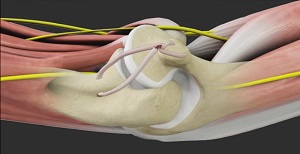 Ulnar Nerve Release Littleton, Douglas County