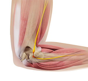 Ulnar Nerve Transposition Surgery